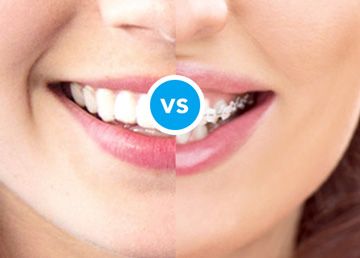 Invisalign