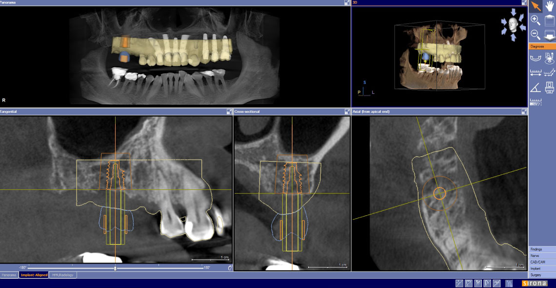 SliderImplant-1